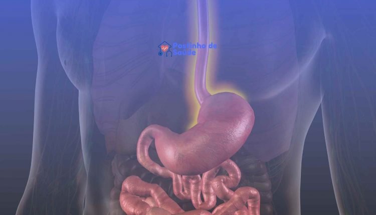 Quais os sintomas de inflamação no esôfago: como diagnosticar e tratar